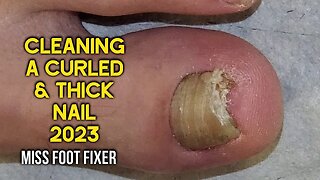 Cleaning Of a Curled & Thick nail 2023👣 Amazing Pedicure Transformation👣 BY MISS FOOT FIXER 向内生长的脚趾甲