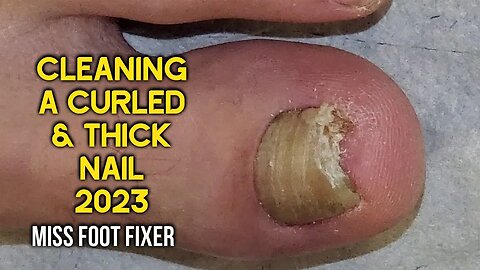 Cleaning Of a Curled & Thick nail 2023👣 Amazing Pedicure Transformation👣 BY MISS FOOT FIXER 向内生长的脚趾甲