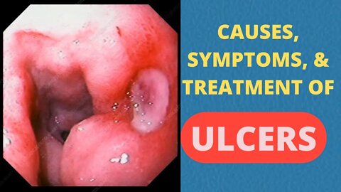 Causes, Signs and Symptoms, Diagnosis and Treatment. of ulcers
