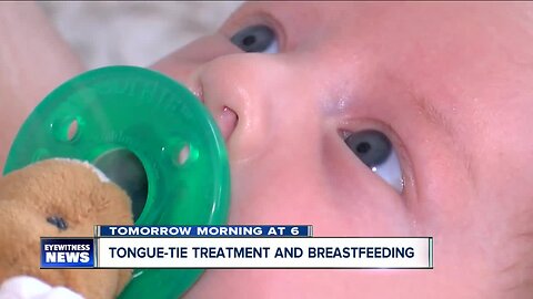 Tongue-tie procedure and breastfeeding