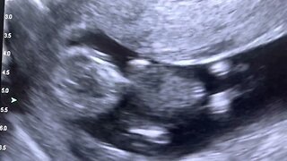Sonogram: Singleton Pregnancy at 11 weeks