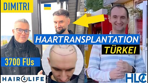 Haartransplantation Türkei: Dimitri`s OP auf eine Vorderkopf-Glatze | HLC