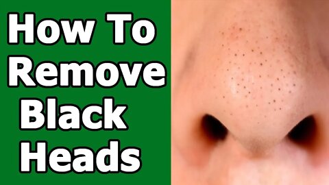 How To Remove Blackheads Naturally [With Baking Soda]