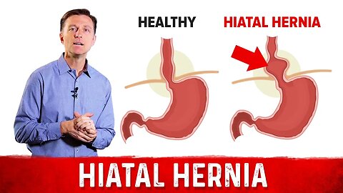 Quick Fix For Hiatal Hernia – Dr. Berg