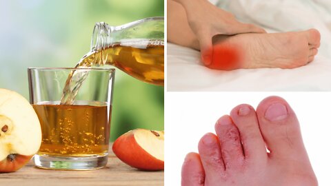 5 Surprising Benefits of Soaking Your Feet In Apple Cider Vinegar!