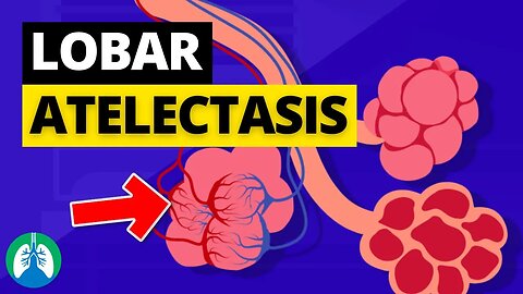 Lobar Atelectasis (Medical Definition) | Quick Explainer Video