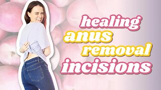Healing My An*s Removal Surgery Incision | Let's Talk IBD