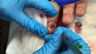 Removal of large granuloma of finger