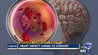 Heart Defect Linked to Strokes