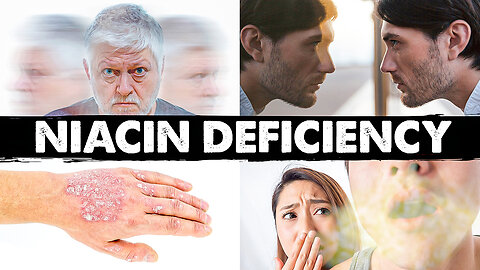 Strange & Weird Niacin (B3) Deficiency Signs and Symptoms