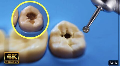 How To Eliminate Caries 🦷 - Just Crazy 😱