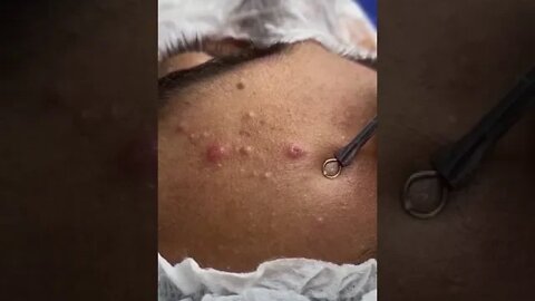 Curta o Momento - Remove Squeezing Blackheads and Pimples - Just Relax | Apenas Relaxe