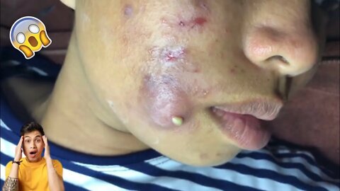Espremendo Espinha Inflamada!! Retirando cravos inflamados !! Inflamed Pimples!! Acne Treatment!!