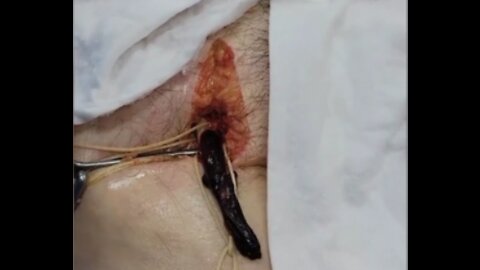 HORRIFYING Proof the "Vaccinated" are getting HUGE Worm like Clots that is KILLING THEM