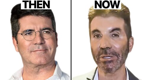 Mr Simon cowell new face plastic surgery enalysis