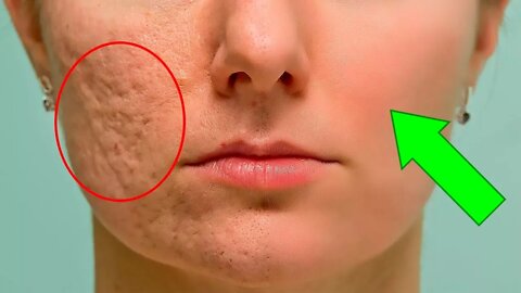 How To Get Rid Of Acne Scars And Pimple Marks