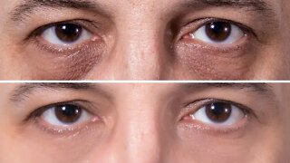 How To Get Rid of Dark Circles Permanently