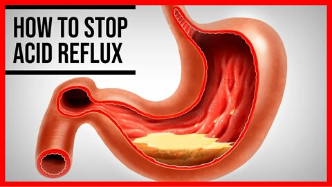 3 Home Remedies for Acid Reflux That Really Work