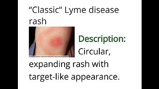 You aren't Crazy ~ You just have Lyme disease