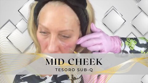 Mid Cheek Filler with a Cannula - SASSY10 Saves 10%