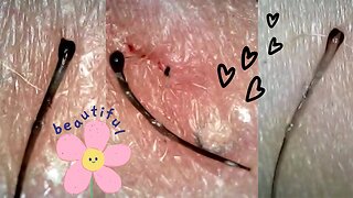 JUICY ROOTS Hair Follicle Plucks! Super Satisfying Hair Removal Under Microscope!