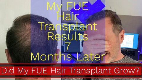 Joe Tillman Dr. Wong FUE Hair Transplant 7 Month Update