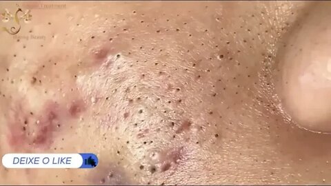 Face full of blackheads and big pimples. Beautiful blackhead removal/extraction