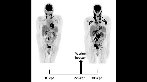 2013 mRNA Trial?