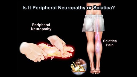 Is It Peripheral Neuropathy or Sciatica - Everything You Need To Know