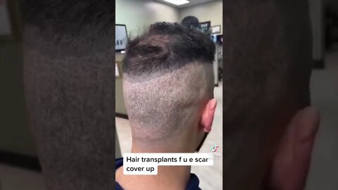 Hair Transplants TikToks I Found Today April 27th, 2022