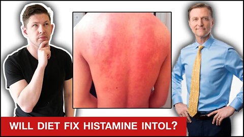 Best & Worst Foods to Stop Histamine Intolerance FAST - Dr. Berg Video Review