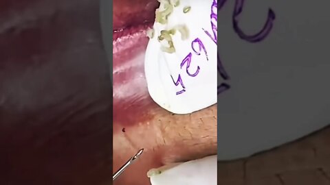 Bottom Lips Blackhead Removal PART 3