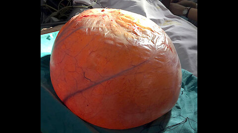 Doctors in india successfully removed a pumpkin-size ovarian cyst