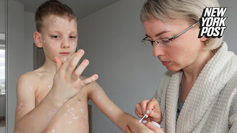 Measles cases surge nearly 80% in wake of Covid chaos, with fears other diseases could follow