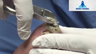 GIANT CALLUS ON TOE - INGROWN TOENAIL REMOVAL - UNHA ENCRAVADA