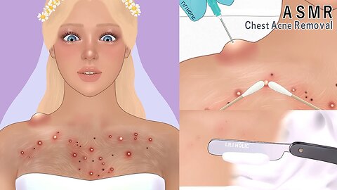 [ASMR] Satisfying! chest acne blackhead removal | animation | pimples skin care | bridal spa