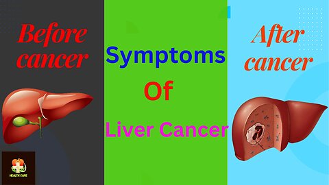 What are Symptoms, Causes and Treatment of Liver Cancer