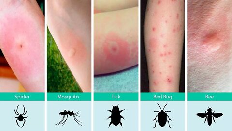 Ouch, What Bit Me? How to Identify Common Bug Bites and What To Do About It