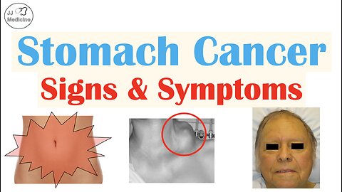 Stomach Cancer Signs and Symptoms | Clinical Manifestations of Gastric Cancer