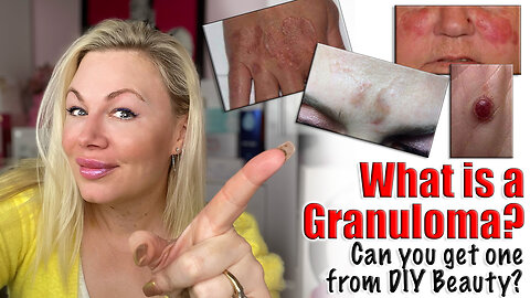 What is a Granuloma and should you be Concerned ?| Code Jessica10 saves you Money at Approved Vendor