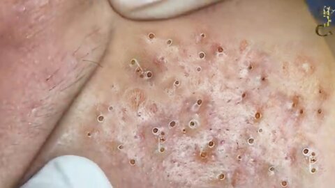 Removing Acne and Blackheads Treatment, #37