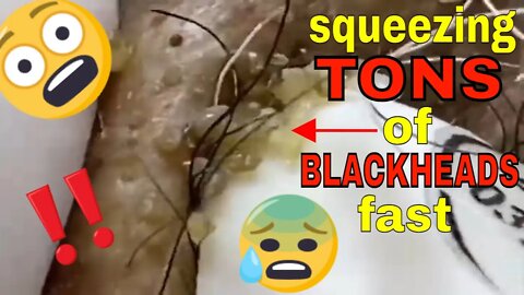 Squeezing tons of blackheads fast 😨🪱 #blackheadremoval #blackhead #blackheads #blackheadsremoval