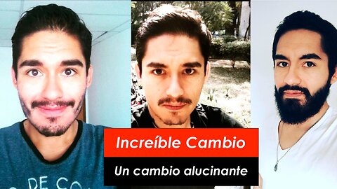 El increíble cambio de un cliente que a usado minoxidil por 3 años