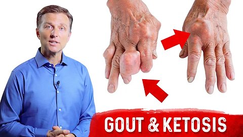 Gout & Ketosis – Uric Acid Stones & High Uric Acid On Keto – Dr. Berg