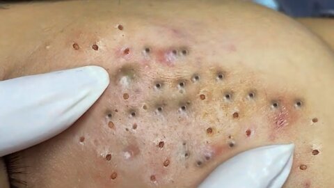 Blackheads, Blackhead Removal, Acne Extraction Relaxing #57