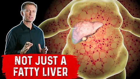 A Fatty Liver Spreads to All of Your Organs