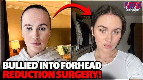 ‘Fivehead’: Woman bullied into $11k forehead reduction surgery
