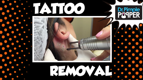 Tattoo Removal