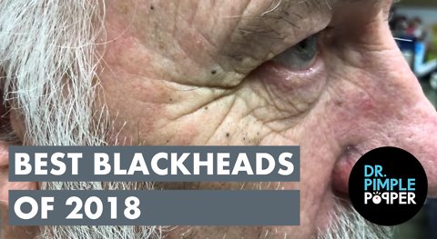 best blackheads 2018