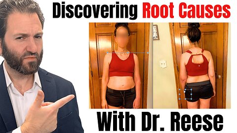 Shocking Discovery: Dr. Reese Identifies Taylors Bunion, Pelvic Tilt and More